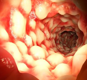 Discovery of novel targets and therapeutics for Crohn’s disease