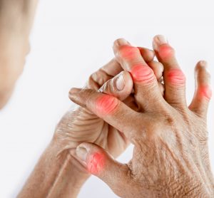 Woman holding her swollen finger joints - idea of gout arthritis