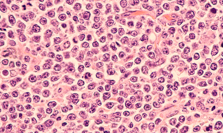 Lymphoma cells