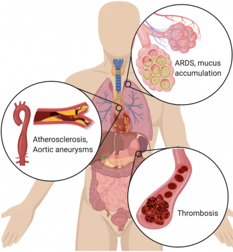 Symptoms NETs can cause, including atherosclerosis, aortic aneurisms, mucus buildup in the lungs, ARDS and thrombosis