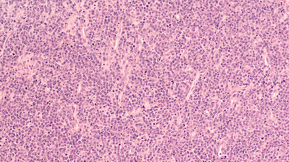 Mantle Cell Lymphoma