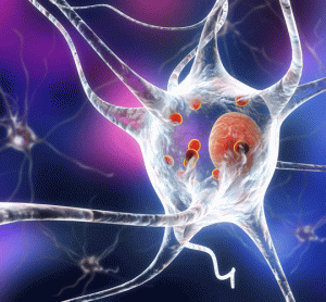 Parkinson's Disease dopamine neuron with alpha-synuclein Lewy Body inside