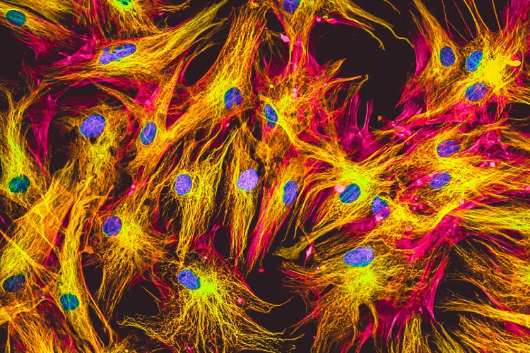 Real fluorescence microscopic view of human fibroblasts in culture. Nucleus are in blue, actin filaments are in pink, tubulin was labelled with green.