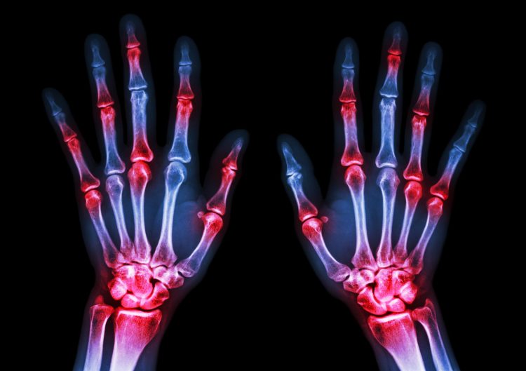 X-ray of the back of human hands with joints highlighted in red - idea of joint inflammation due to arthritis