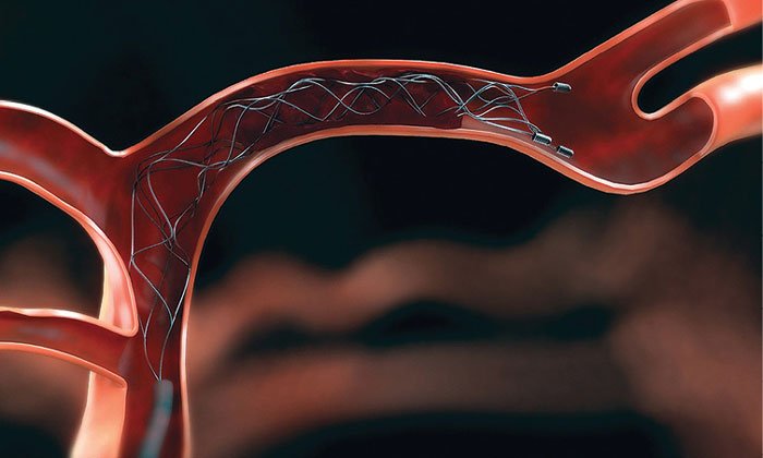 New study proves e-ASPECTS could predict benefit of mechanical thrombectomy