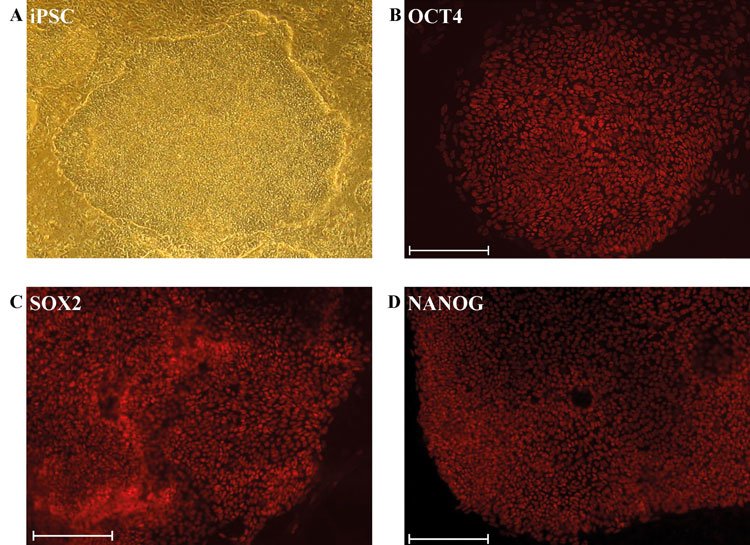 Figure 1: Derivation and characterisation of iPSCs (A) Phase contrast image of an undifferentiated iPSC colony derived from dermal fibroblasts. Immunofluorescence-based detection of expression of the pluripotency-inducing proteins (B) OCT4/POU5F1 (C) SOX2 (D) NANOG. (Scale bar: 200μm)