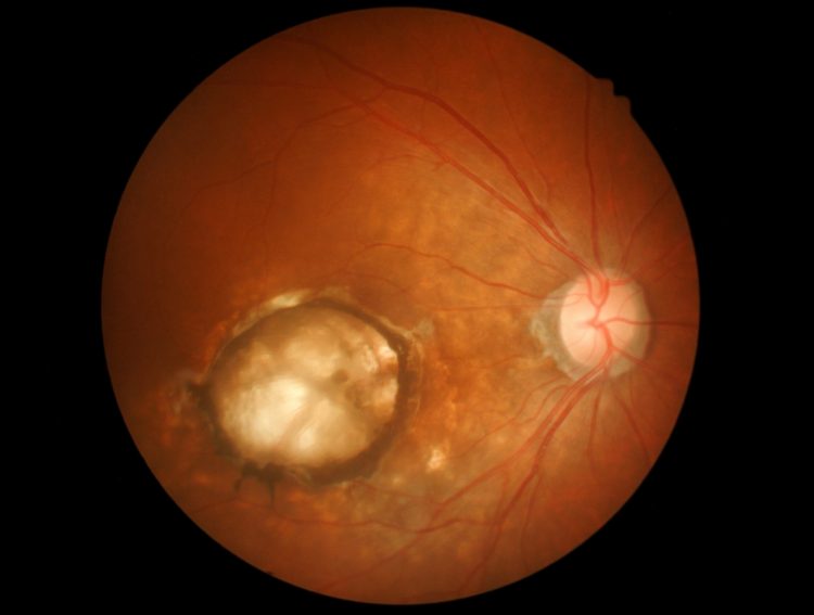 opticians image of the retina with a large area of macular degeneration