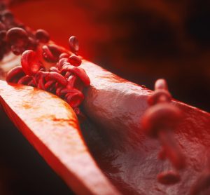 blood vessel thinned by atherosclerosis