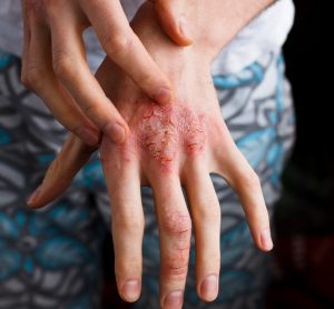 woman with red open sores on her hand - idea of atopic dermatitis flare up