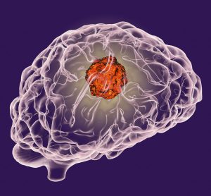 cartoon image of a brain with a large red ball inside representing a tumour