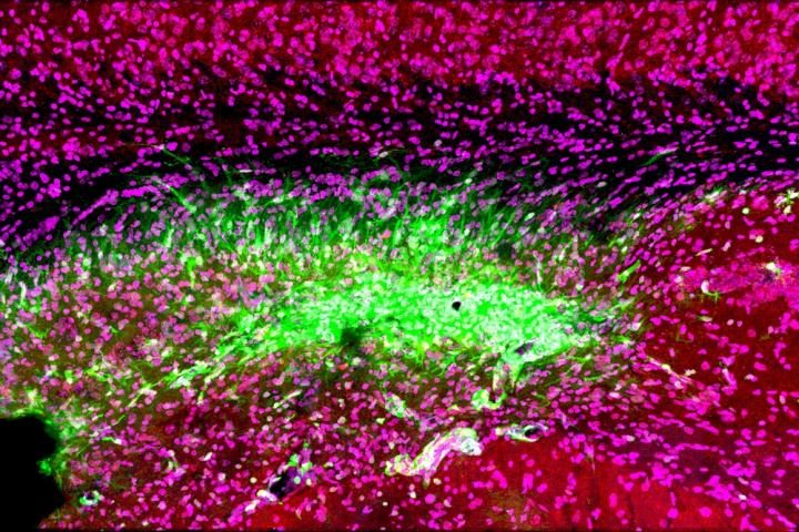 Even after a blocked vessel has been opened, immune cells in the brain (green) continue to attack synapses (red) and neurons (magenta) in the memory center of the brain, the hippocampus, for at least 30 days after stroke.