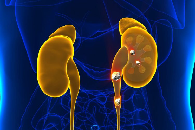 kidney stones
