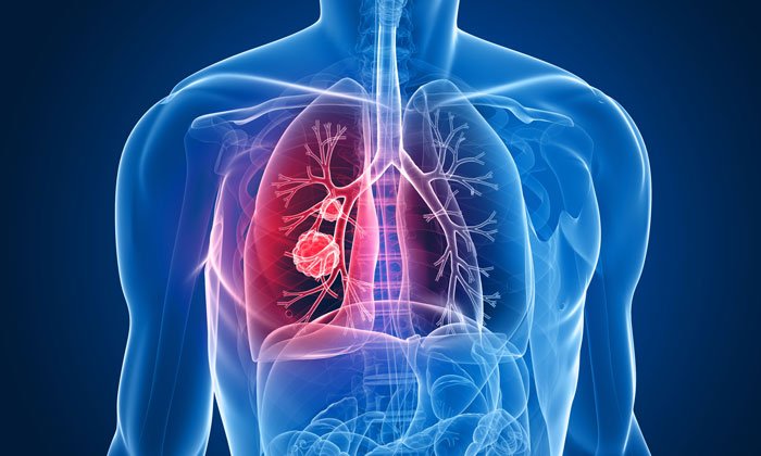 New biomarker identified for early diagnosis of lung cancer