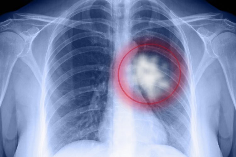 x-ray of chest with lung cancer circled in red