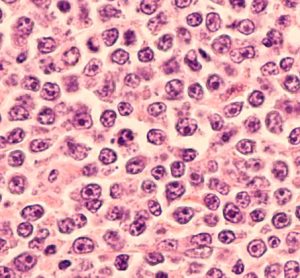 Genomic analysis unravels complexities of the most common form of lymphoma