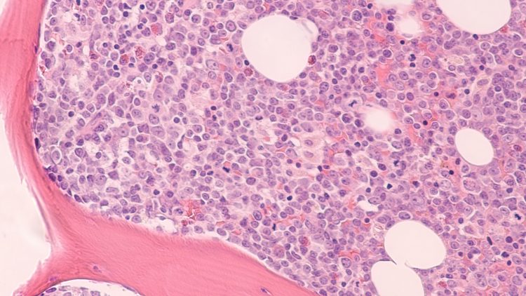 Photomicrograph of bone marrow biopsy showing myeloblasts of acute myeloid leukemia (AML), a cancer of white blood cells.