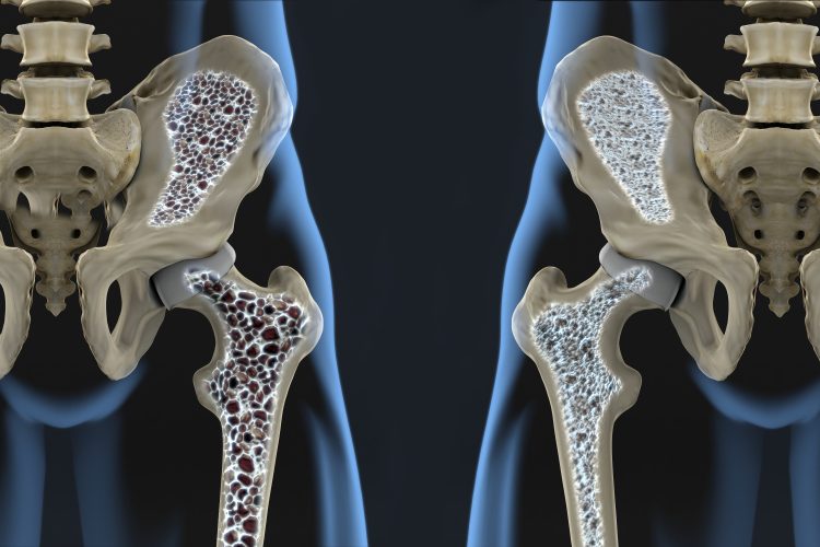 cartoon of two hips and femurs - left on with large black dots in the bone indicating osteoporosis (bone being removed and becoming spongy), the other with smaller dots indicating normal bone