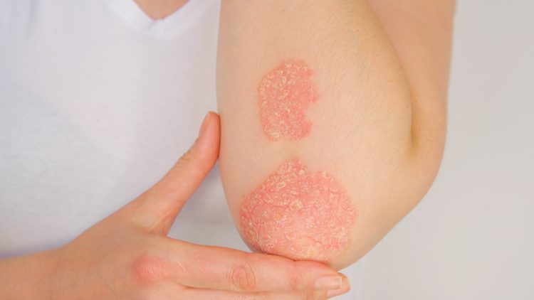 Elbow with psoriasis