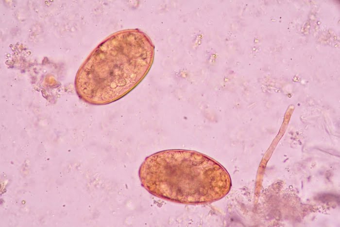 schistosomiasis infections