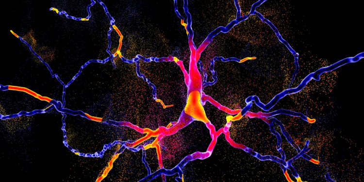 Degeneration of dopaminergic neuron, indicating onset of Parkinson's disease