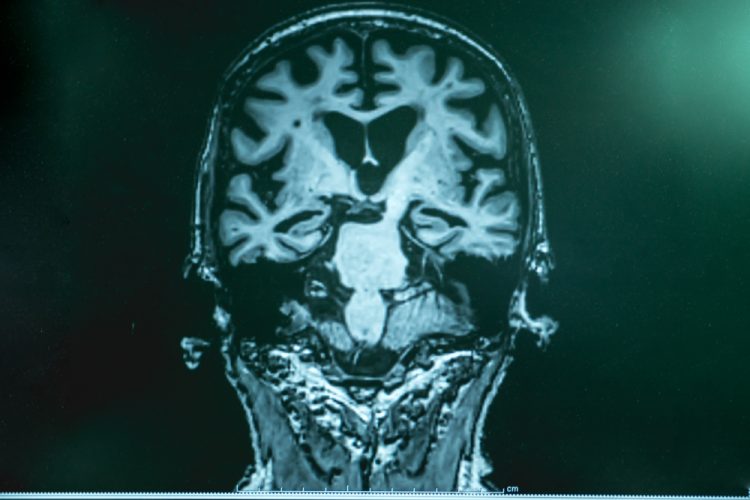 MRI scan of brain with Alzheimer's disease
