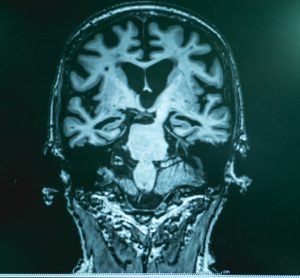 Brain with Alzheimer's