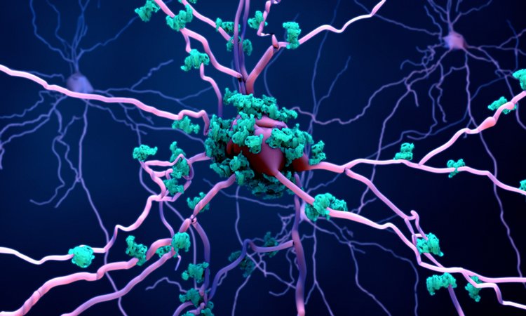 Amyloid fibrils around neurons