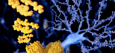 Amyloid plaques growing on a neuron, indicating neurodegeneration