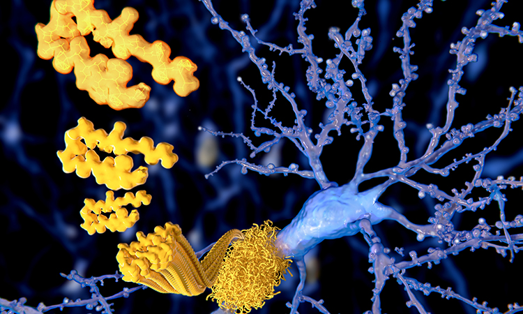 Amyloid plaques growing on a neuron, indicating neurodegeneration