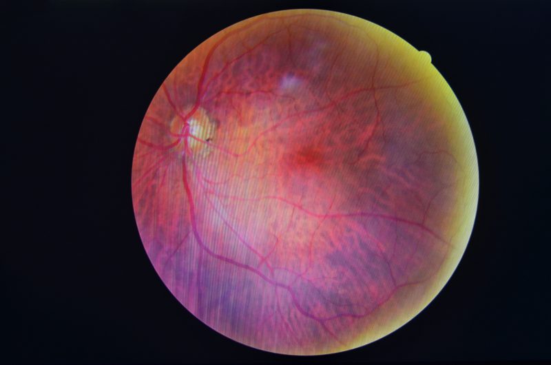 Interventions increase attendance for diabetic retinopathy screening