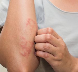 Woman with eczema