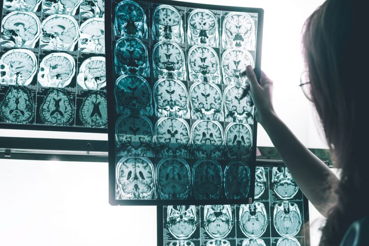 Alzheimer's shown on MRI brain scan